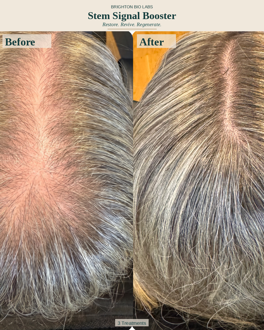 Female Pattern Hair Loss Before and After - 3 Treatments